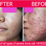 Acne Treatment result by Bliss Skin Clinic in Bandra