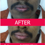 Lip Lightening Treatment in Bandra,Mumbai