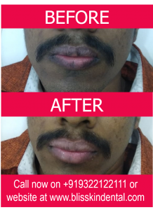 Read more about the article Say goodbye to Dark Lips with Lip Enhancing Laser Treatment Bliss Skin Clinic at Bandra in Mumbai