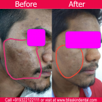 Acne Scare Removal Treatment in Bandra,Mumbai