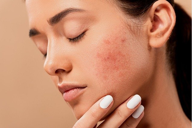 Effective Acne Treatment in Bandra, Mumbai - Bliss Clinic