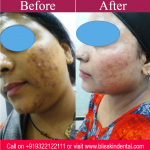 Best Acne reduction Treatment in Bandra,Mumbai