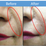 Smile Wrinkle Removal Treatment in Bandra