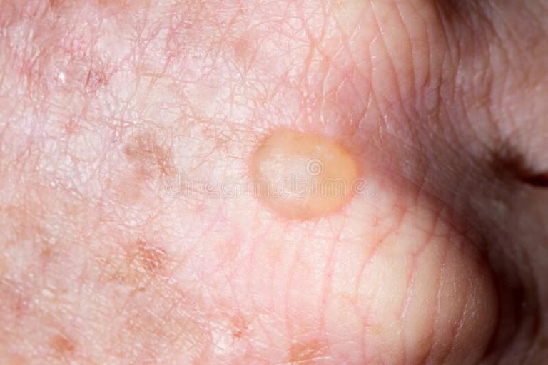 Actinic Keratosis Treatment by best dermatologist in Bandra