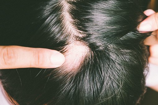 Hair Loss and Alopecia: When Should I See a Dermatologist? - Premier  Dermatology Group | Dermatology