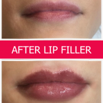 Lip Filler Treatment at Bliss Skin Clinic in Bandra