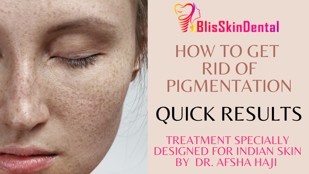 Intralesional Therapy For Melasma And Pigmentation Now At Bliss Skin