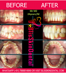 Read more about the article Dentist in Bandra for treatment of crowding of teeth