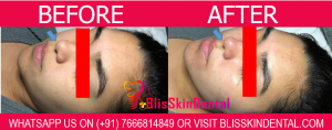 Read more about the article Black Head Removal Treatment in Bandra,Mumbai