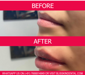 Read more about the article Lip Augmentation and Filler Treatment in Bandra-Mumbai