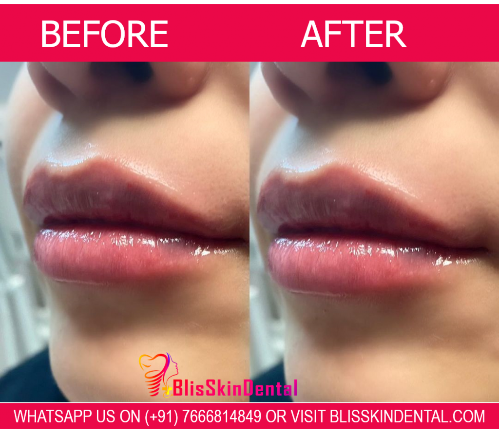 Benefits of Hyaluronic Acid Fillers for Fuller Lips
