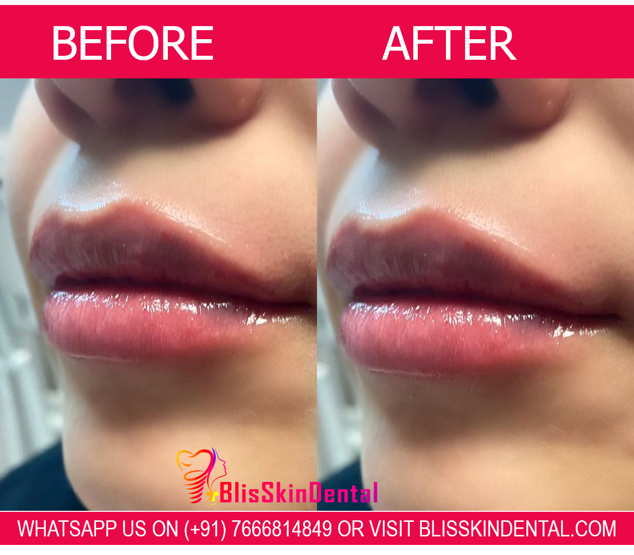 Read more about the article Benefits of Hyaluronic Acid Fillers for Fuller Lips