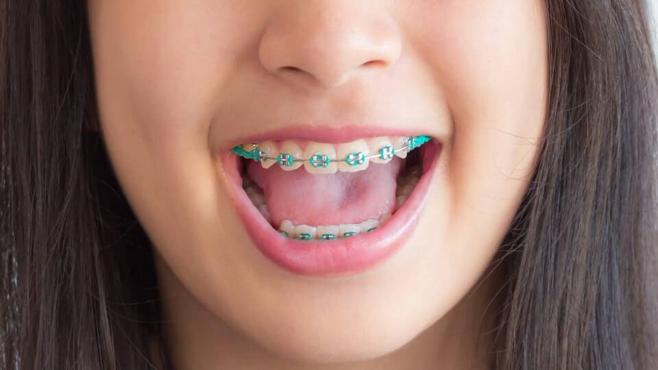 Read more about the article Benefits of Braces for Kids Explained by Dentist in Bandra