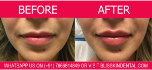 Read more about the article Dermal fillers in Mumbai. For improvement of facial aesthetics