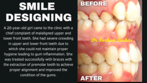 Read more about the article Teeth Straightening Treatment in Bandra,Mumbai | Dental Braces by Best Orthodontist (Dentist)