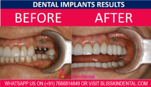 Read more about the article Dental Implant in Bandra Mumbai |  Dental Implants by Orthodontics