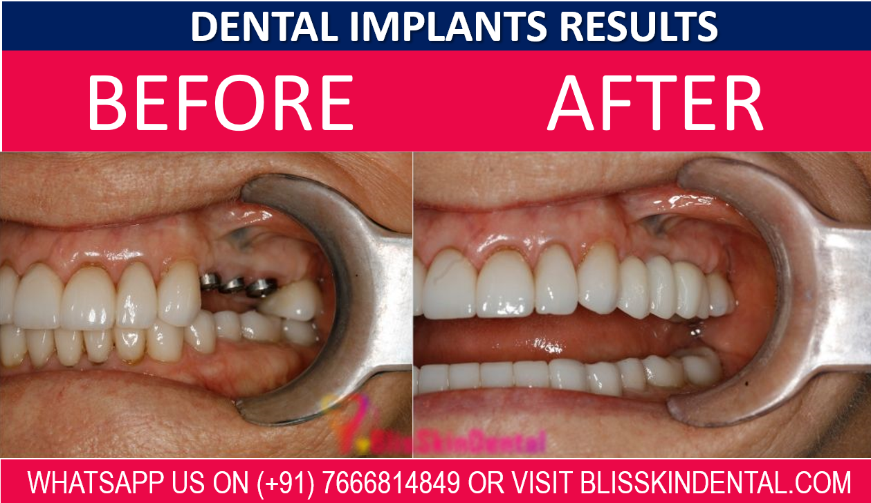 You are currently viewing Dental Implant in Bandra Mumbai |  Dental Implants by Orthodontics