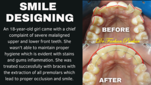 Read more about the article Teeth Straightening Treatment with Braces in Bandra | Straightening Teeth (invisalign) In Bandra.