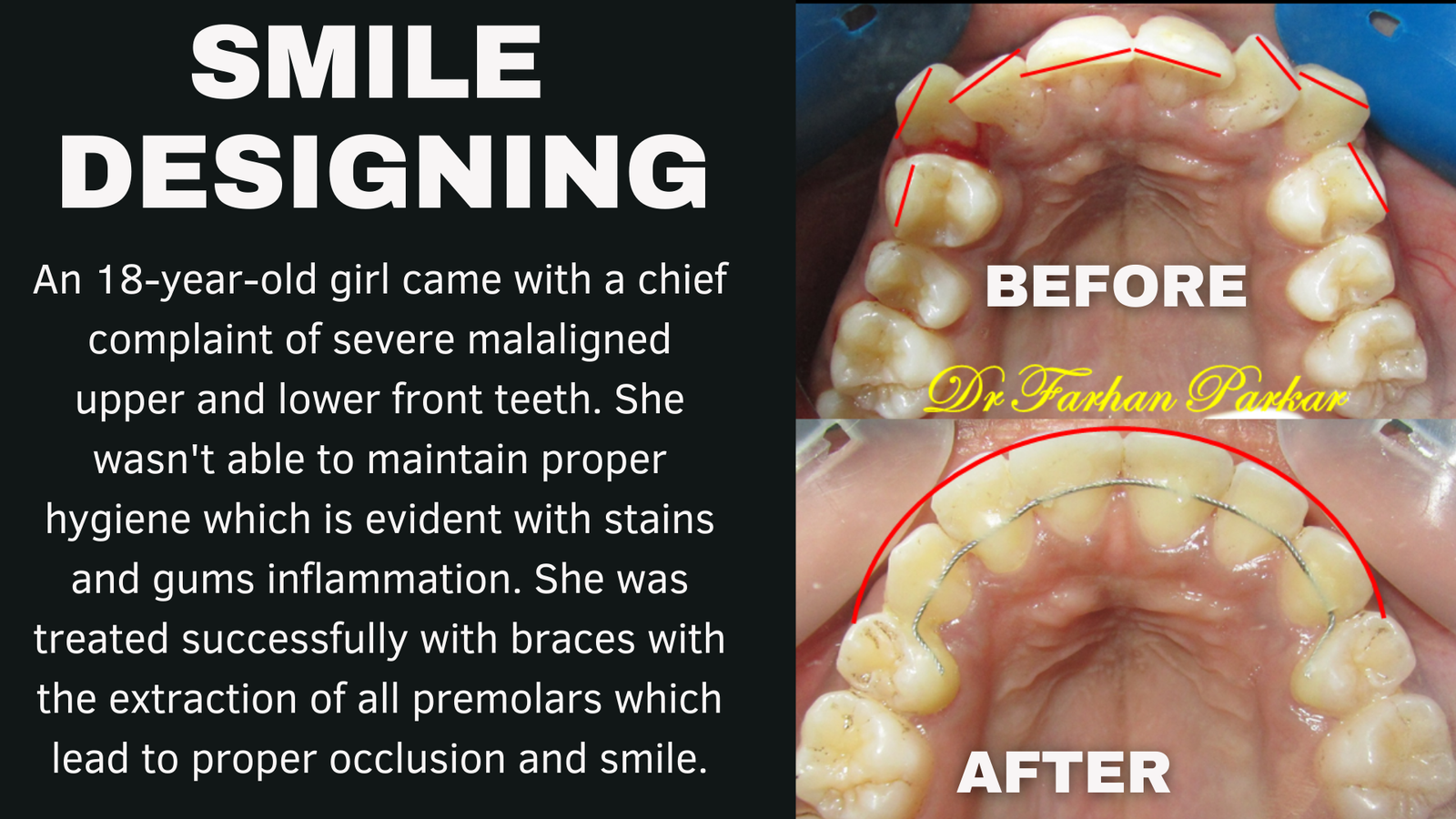 You are currently viewing Teeth Straightening Treatment with Braces in Bandra | Straightening Teeth (invisalign) In Bandra.