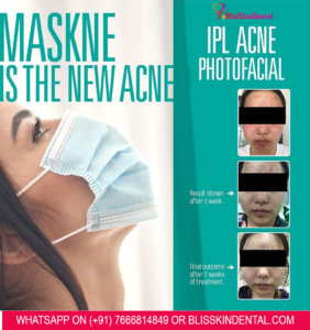 Read more about the article Acne Treatment for pimples caused by Wearing Mask