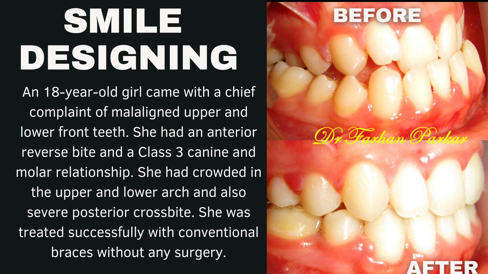 Read more about the article Best Dentist in Bandra | Orthodontist in Bandra