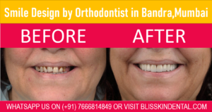 Read more about the article Smile Design Treatment By Orthodontist in Bandra