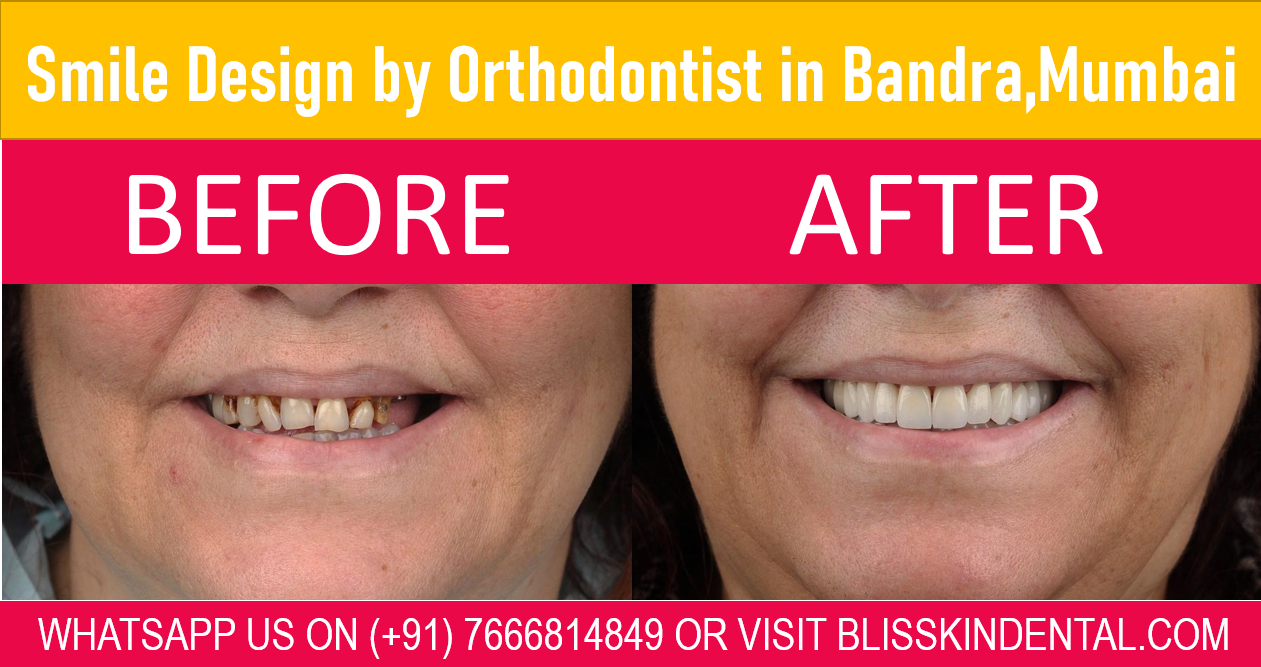 You are currently viewing Smile Design Treatment By Orthodontist in Bandra