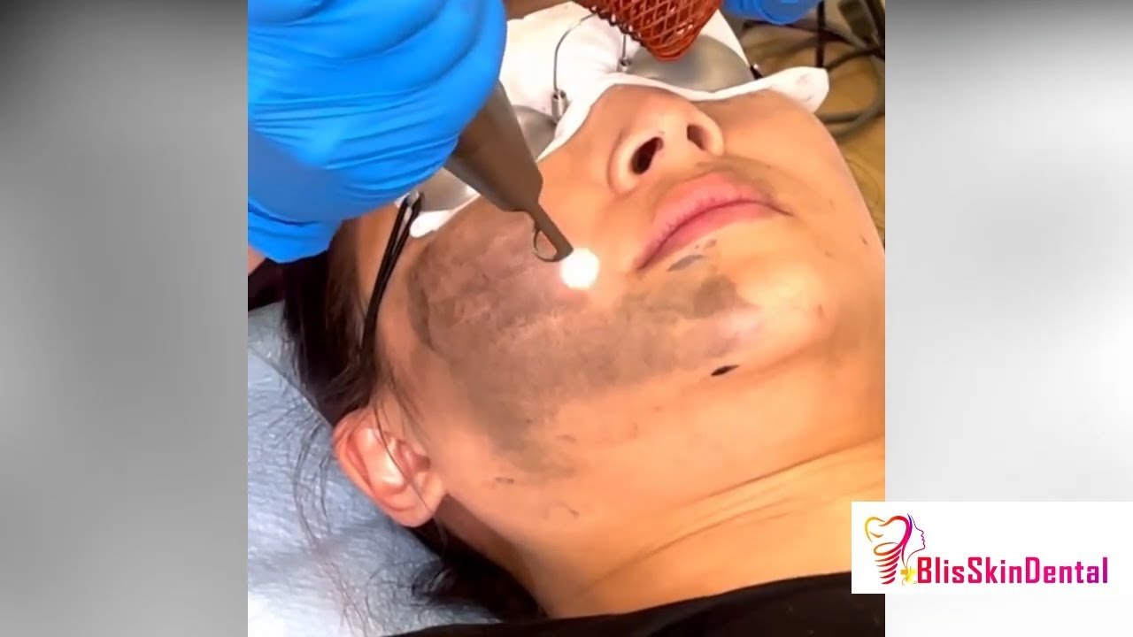 Read more about the article Carbon Peel at Bliss Skin Clinic in Bandra,Mumbai