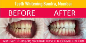 Read more about the article Teeth Whitening Treatment | Dental Clinic in Bandra Mumbai