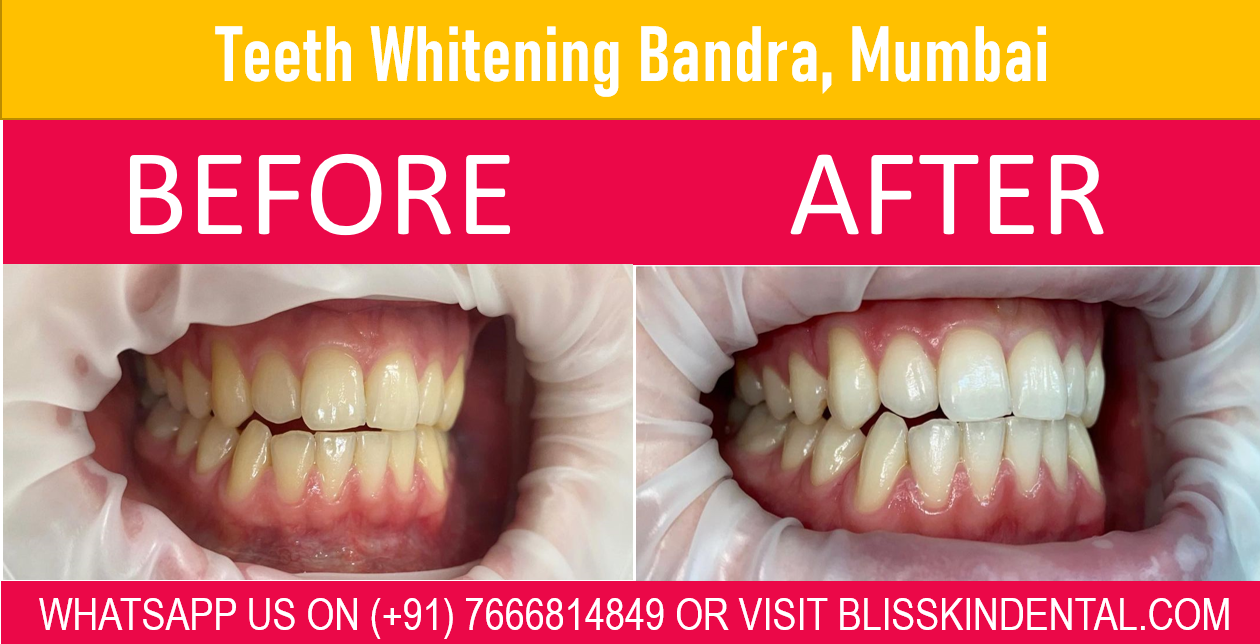 Read more about the article Teeth Whitening Treatment | Dental Clinic in Bandra Mumbai