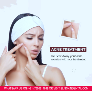Read more about the article Acne Treatment in Bandra, Mumbai