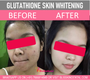 Read more about the article Skin Whitening Treatment in Bandra,Mumbai