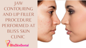 Read more about the article Jaw Contouring and Lip Filler Procedure Performed at Bliss Skin Clinic in Bandra,Mumbai
