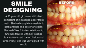 Read more about the article Braces and Aligners for teeth straightening in Bandra, Mumbai
