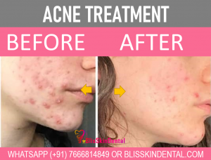 Read more about the article Best Acne Treatment in Bandra,Mumbai