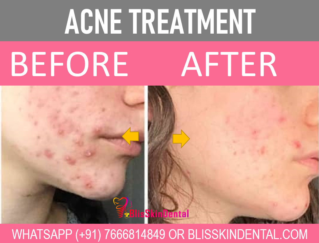 You are currently viewing Best Acne Treatment in Bandra,Mumbai