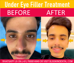 Read more about the article Under Eye Dark Circle and Under Eye Bag Removal in Bandra Mumbai at Bliss Skin Clinic