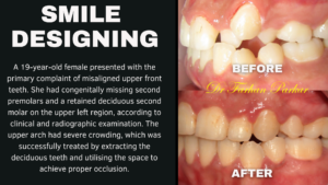 Read more about the article Teeth Straightening Treatment with Best Dentist in Bandra Mumbai