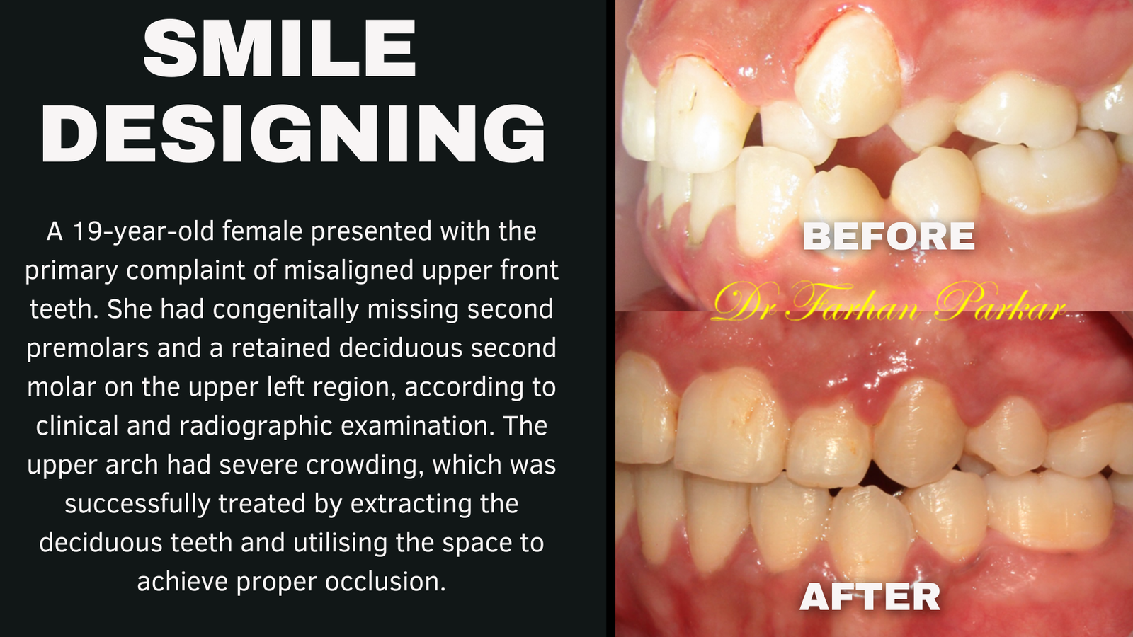 You are currently viewing Teeth Straightening Treatment with Best Dentist in Bandra Mumbai