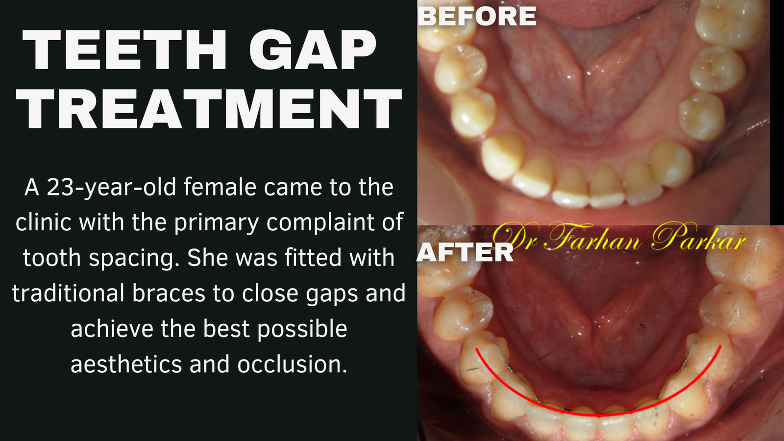 Read more about the article Closing Teeth Gap Dental Treatment in Bandra,Mumbai at Bliss Dental Clinic