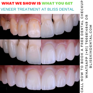 Read more about the article Dental Veneers Treatment in Bandra, Mumbai