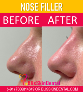 Read more about the article Non-surgical Nose Job with Dermal Fillers in Bandra,Mumbai
