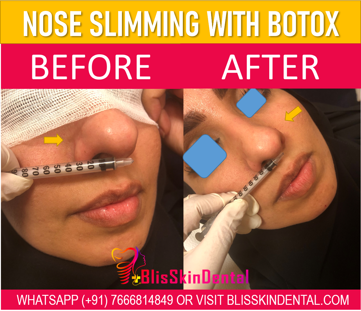 Read more about the article Botox for slimming wide nose in Bandra, Mumbai