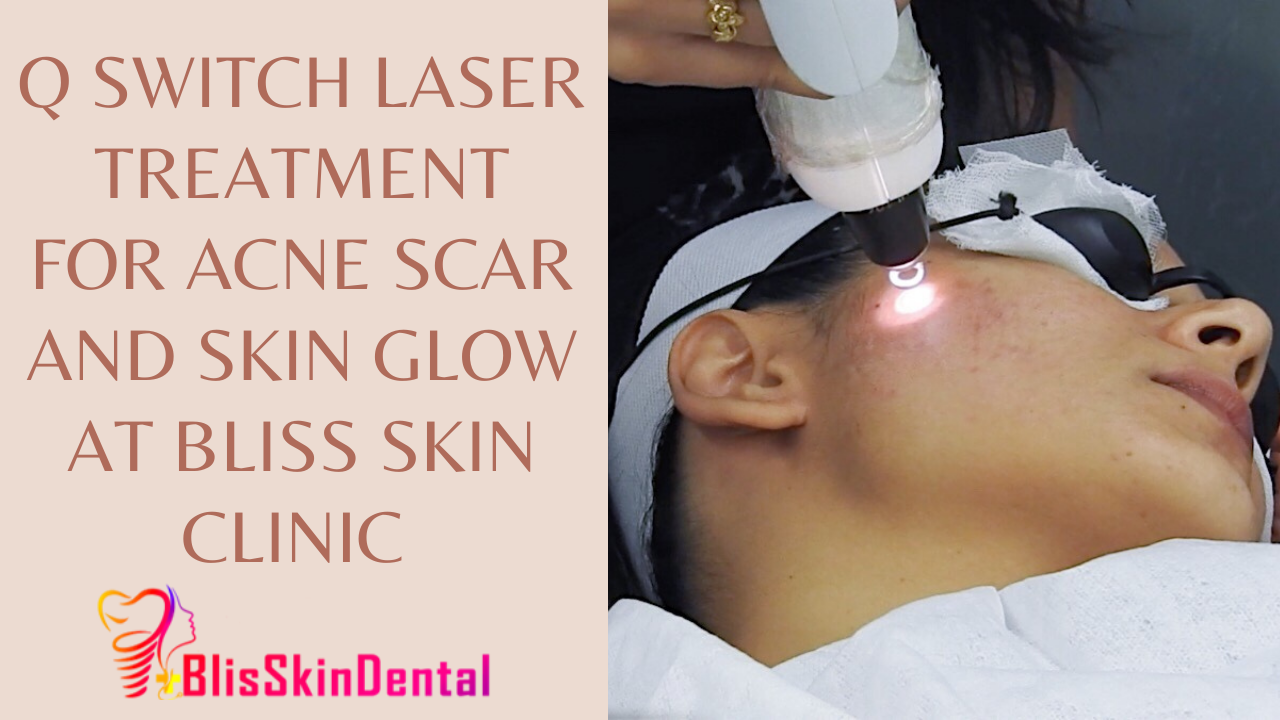 You are currently viewing Q Switch Laser Treatment for Acne Scar and Skin glow at Bliss Skin Clinic