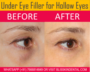 Read more about the article Best Under Eye Filler for Hollow Eyes and Tear Trough in Bandra, Mumbai