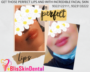 Read more about the article Perfect Lip Augmentation by Bliss Skin Clinic in Bandra, Mumbai
