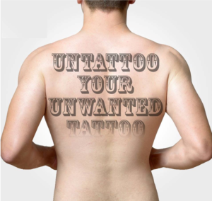 Read more about the article Tattoo Removal Treatment in Bandra,Mumbai at Bliss Skin Clinic