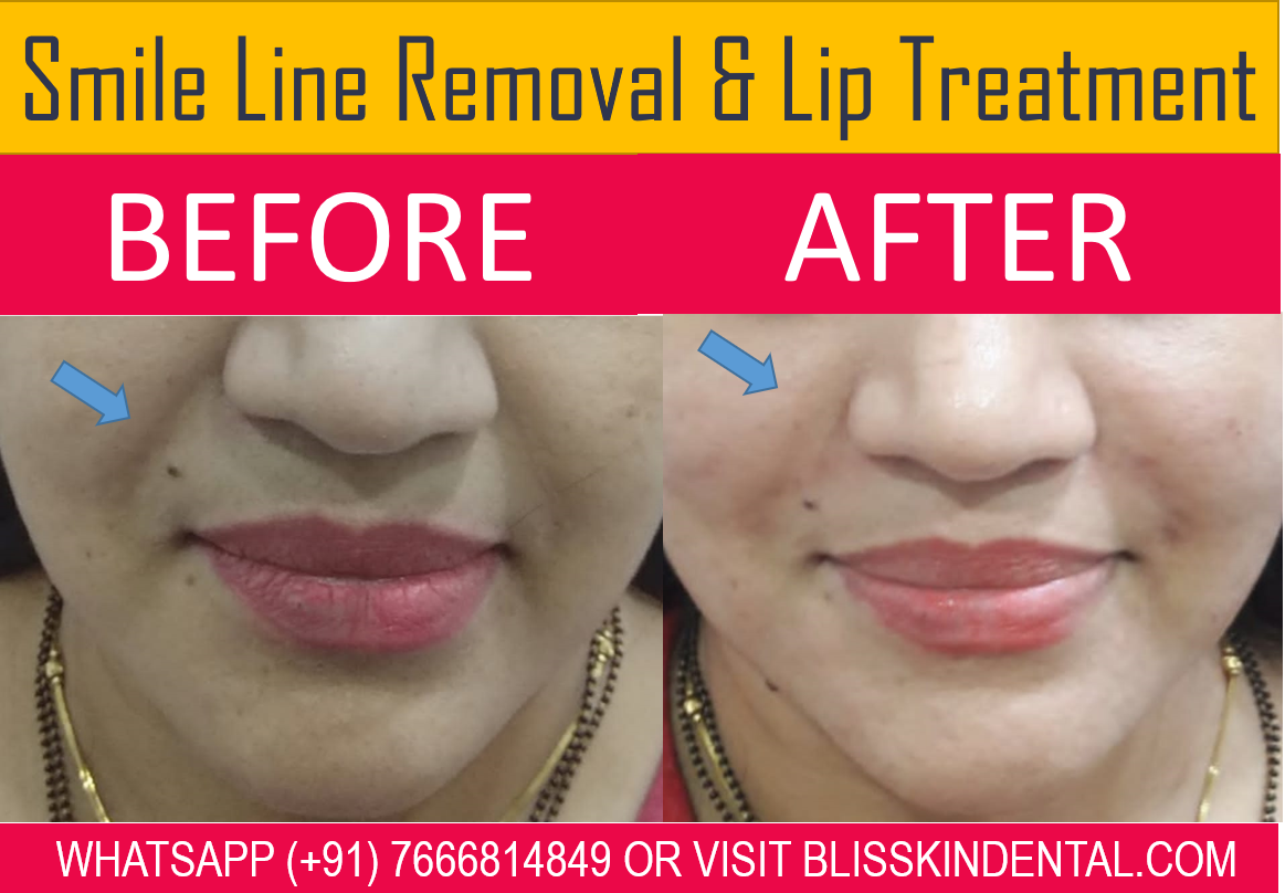 Read more about the article Smile line Removal Treatment in Bandra, Mumbai
