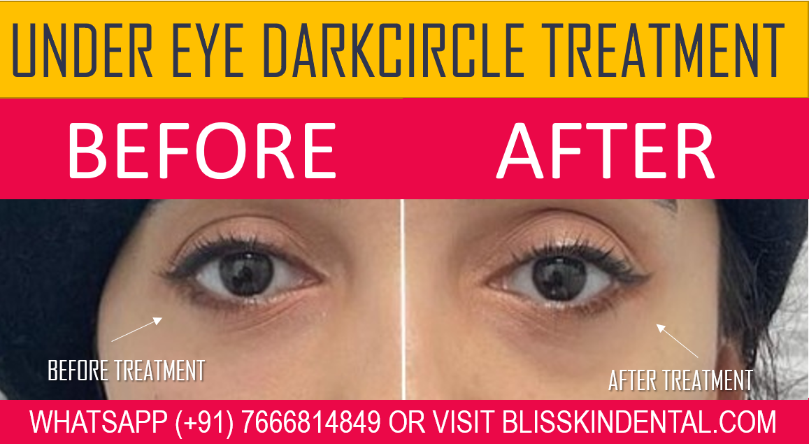 Read more about the article DARK CIRCLES UNDER EYES TREATMENT IN MUMBAI