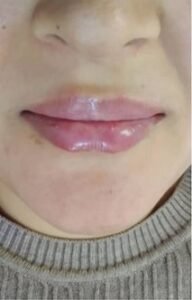 Read more about the article Lip Augmentation with Lip Fillers in Mumbai by Bliss Skin Clinic at Bandra